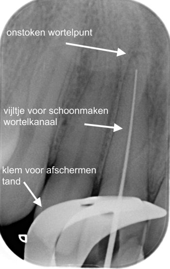 Wortelkanaal met vijlgereedschap