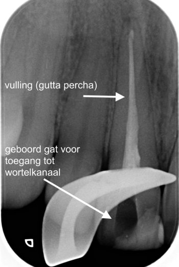 Wortelkanaal gevuld met gutta-percha